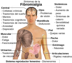 HOMEOPATIA EN LA FIBROMIALGIA homeopatia en la fibromialgia: