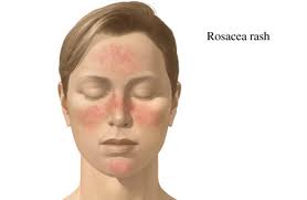 Ratschläge bei Rosacea