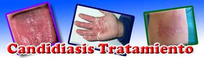 CANDIDIDASIS 2