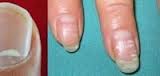 Uñas con manchas blancas ¿porqué?
