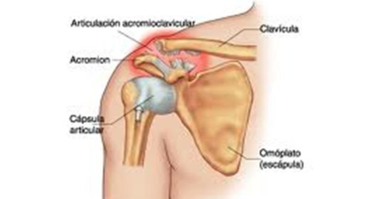 Luxación glenohumeral
