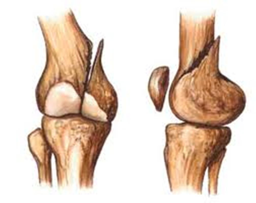 Повреждения мыщелка бедренной кости