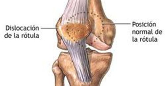 Esguince del ligamento colateral medial de la rodilla