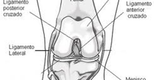 Esguince del ligamento lateral de la rodilla