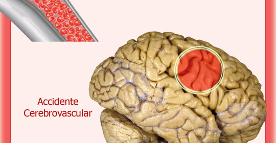 Accidentes cerebrovasculares