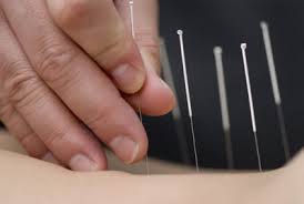 acupuntura para el dolor