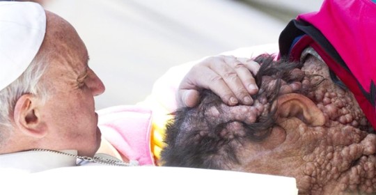 Neurofibromatosis
