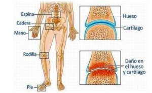 tratamiento de artrosis en madrid