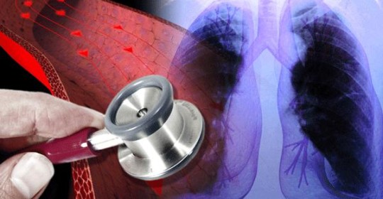 La hipertensión pulmonar y su difícil tratamiento