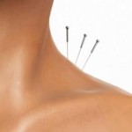tratamientos de acupuntura en madrid