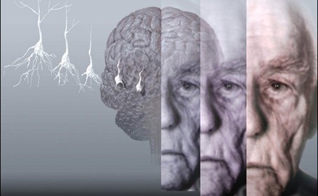 El diagnostico de la enfermedad de Alzheimer